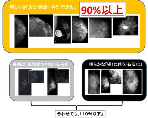 微細石灰化の集簇|乳がん検診のマンモグラフィ検査で石灰化があった場合について。